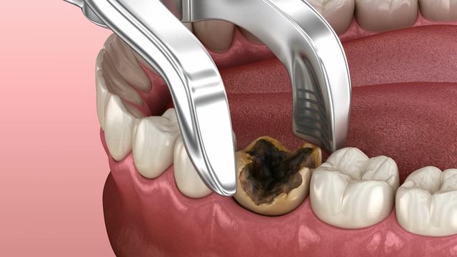 Extraction of Molar tooth damaged by caries. Medically accurate tooth 3D animation