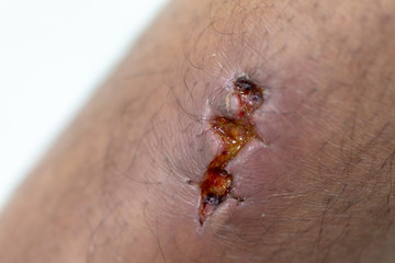 Closeup injured at leg, Fresh wounds from accident. 