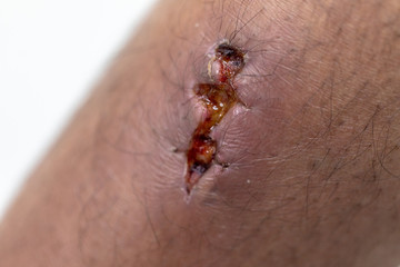 Closeup injured at leg, Fresh wounds from accident. 