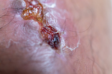 Closeup injured at leg, Fresh wounds from accident. 