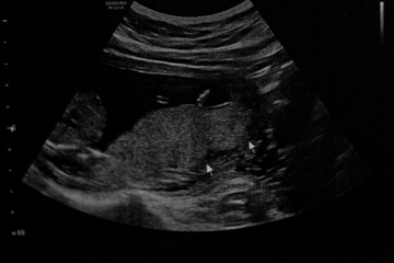 Ultrasound of baby in pregnant woman, Doctor reading test results of pregnant woman by ultrasound.