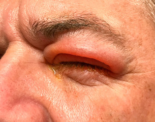 Obraz premium Detail of badly swollen upper eyelid of a man