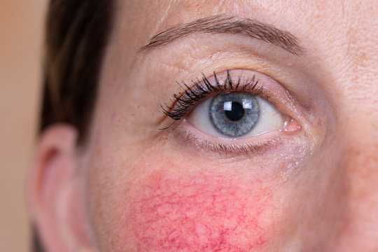 A closeup view on the face of a young woman suffering with rosacea on her cheeks and beneath her nose. Red blotches and prominent blood vessels are seen in detail.