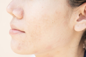 Scar from Acne on face
