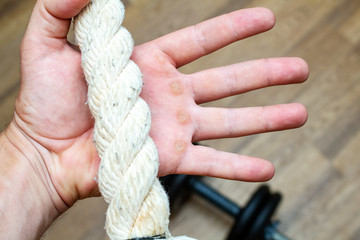 Hand with rope corn, callus, callosity, induration, congelation on the palm because of physical activity sports gym sport concept