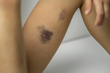 Big Bruise on child thigh.
