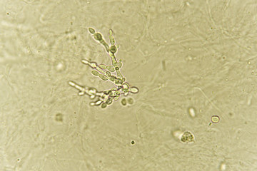 Pseudohyphae and budding yeast cells in patient urine (urinary tract infections), analyze by microscope