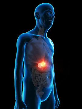 3d rendered medically accurate illustration of an old mans pancreas tumor