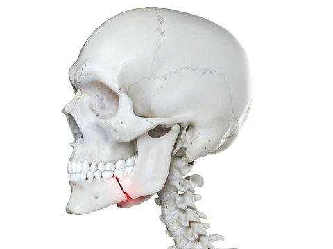 3d rendered medically accurate illustration of a broken jaw
