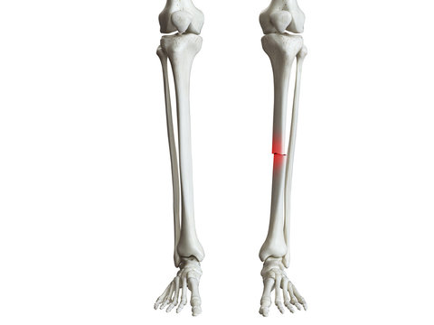 3d rendered medically accurate illustration of a broken tibia