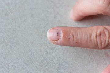 Index finger with subungual hematoma. - 284874944