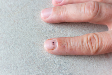 Index finger with subungual hematoma. - 284874950