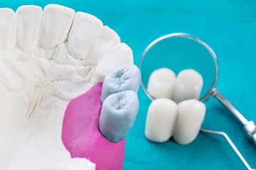 Close up Implan model tooth support fix bridge implan and crown.