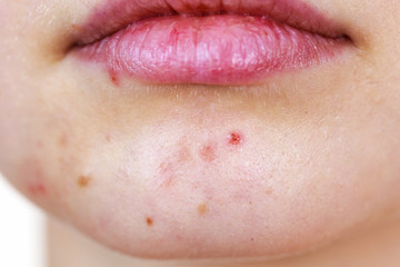 Obraz premium Female face with acne skin problem