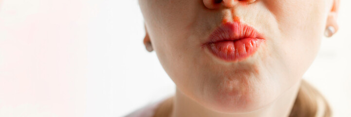 Lower part part of woman face with Red bubbles of virus herpes on her lips, she kisses the air, white background, Zoster, Cold, Medicine, Treatment. Long horizontal banner with copy space