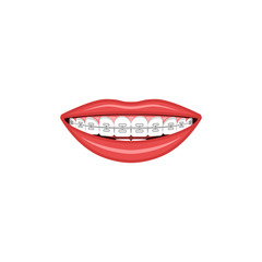 Wide female smile with teeth and braces sign for orthodontist cabinet medical illustration