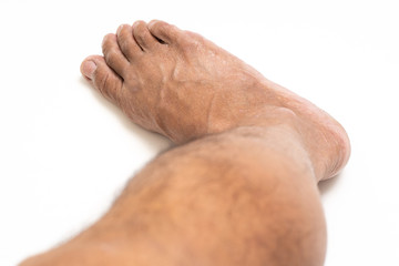 Asian man foot brown and dry skin