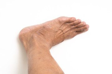 Asian man foot brown and dry skin