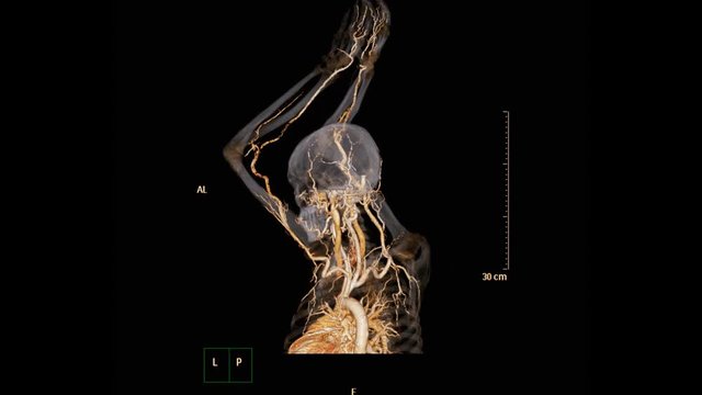 CTA brachial artery or CT scan of upper extremity 3d rendering image  for diagnosis brachial artery stenosis .