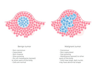 Vector  illustration of malignant and benign tumor - obrazy, fototapety, plakaty