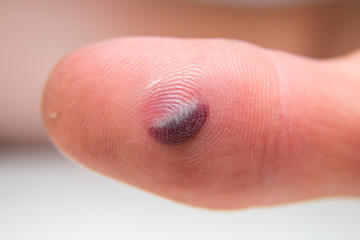 Blood blister under the thumb skin. Caucasian young man finger on white background