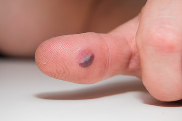 Fototapeta premium Blood blister under the thumb skin. Caucasian young man finger on white background
