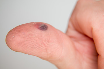 Blood blister under the thumb skin. Caucasian young man finger on white background
