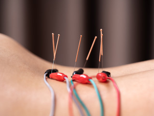 woman undergoing acupuncture treatment with electrical stimulator on back - obrazy, fototapety, plakaty