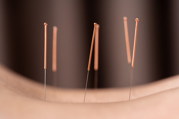 woman undergoing acupuncture treatment on back - obrazy, fototapety, plakaty