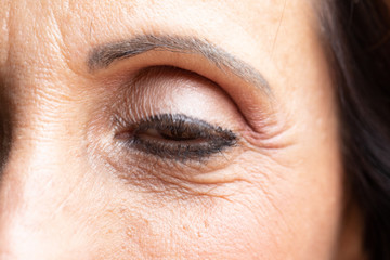 Closeup of female eye with ptosis: drooping eyelid, amblyopia condition called lazy eye.