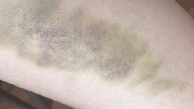 Video close-up of a large bruise and hematoma on the skin of the hip of a woman. The concept of pain close-up