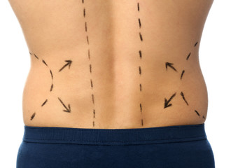 Young man with marks on body for cosmetic surgery operation against white background, closeup