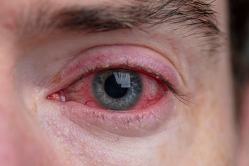 Close up of a severe bloodshot eye. Blepharitis, Conjunctivitis condition