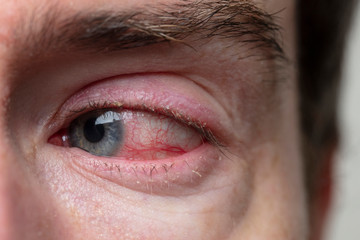 Close up of a severe bloodshot eye. Blepharitis, Conjunctivitis condition
