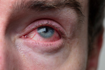 Close up of a severe bloodshot eye. Blepharitis, Conjunctivitis condition