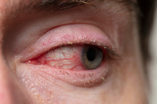 Close up of a severe bloodshot eye. Blepharitis, Conjunctivitis condition