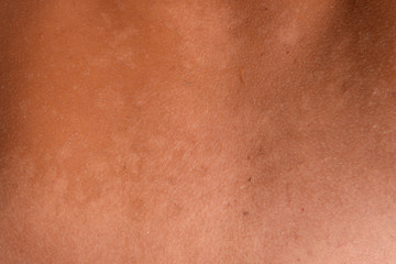 Sunburn on the skin of the back. Exfoliation, skin peels off. Dangerous sun tan