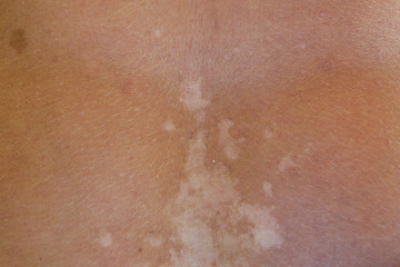Fototapeta premium Sunburn on the skin of the back. Exfoliation, skin peels off. Dangerous sun tan