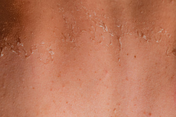Fototapeta premium Sunburn on the skin of the back. Exfoliation, skin peels off. Dangerous sun tan
