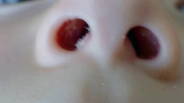 Consisting of nasal congestion in babies, infants clogged nose,