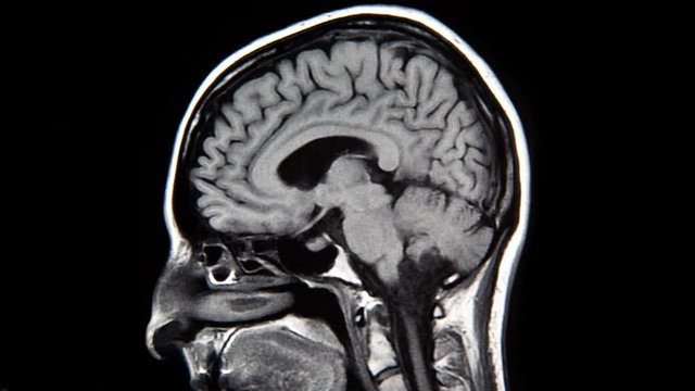 Stop motion animation made with sagittal MRI scans of a human brain.