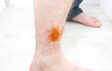 Fototapeta premium The bite sign on the man's leg. Dangerous wound. Antiseptic on skin. Medical problem photo.