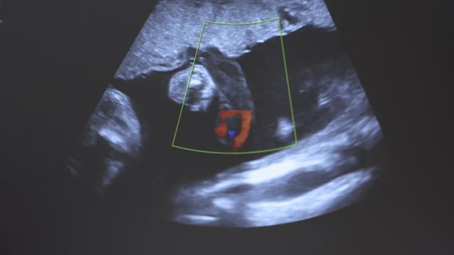 color doppler ultrasound showing blood flow through the placental cord, 6 moths pregnant mother, baby face showing on the begining