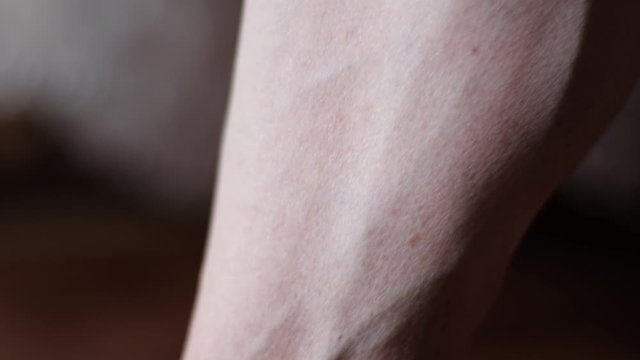 Varicose veins. Female foot with varicose veins, close up