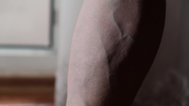 Varicose veins on a female legs. Phlebology