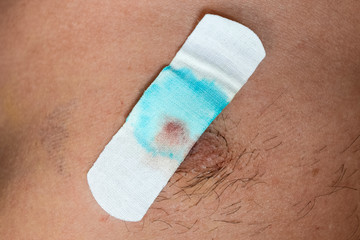 Bactericidal adhesive tape on the male nipple