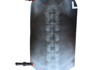 X ray of the lumbar spine, spine on x-ray