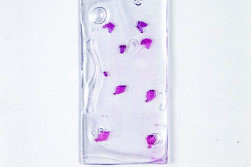 Slices of the tumor under glass. Histological examination of tumor cells for the presence of cancer