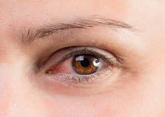 Close up of human eye of woman suffering with ocular rosacea, evident redness due to inflammatory...