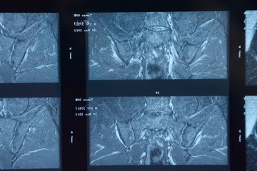 MRI sacroiliac articulation. Study of ankylosing spondyloarthritis patient.